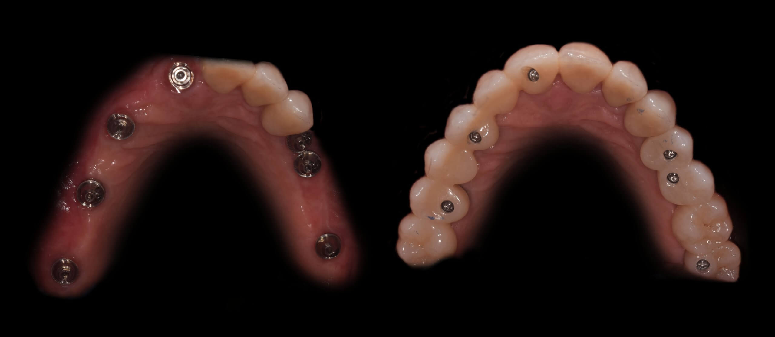 Fester Implantatzahnersatz auf 6-8 Zahnimplantate Leverkusen