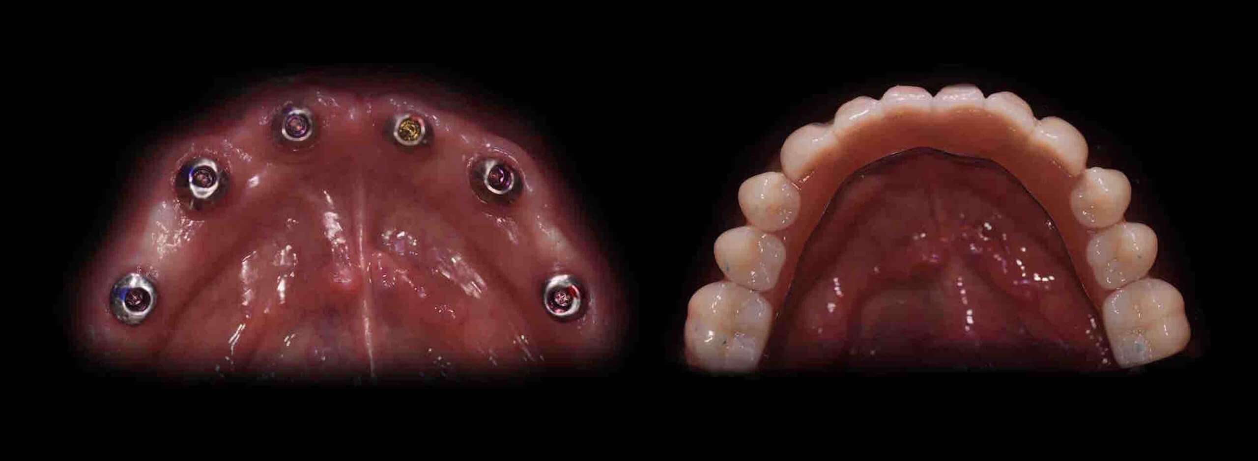 Implantat-Zahnersatz